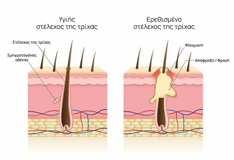 Θυλακίτιδα